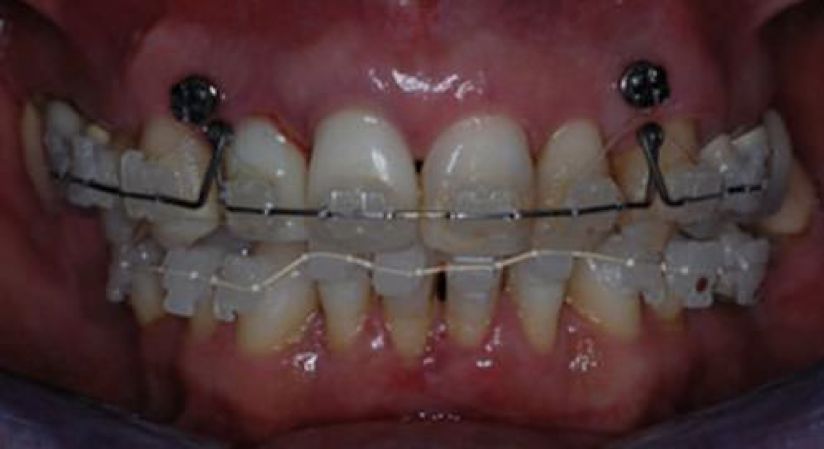 ¿Qué son los MINITORNILLOS? ¿Te han dicho que vas a llevarlos en tu tratamiento de ortodoncia?