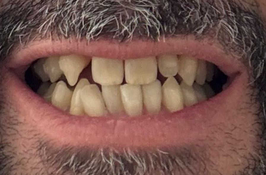 Ortodoncia invisible ¿para qué casos podemos usarla?