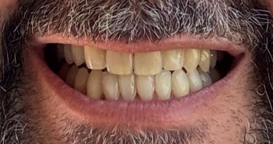 Ortodoncia invisible ¿para qué casos podemos usarla?