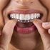 Ortodoncia invisible QUICKSMILE: qué es y cómo funciona