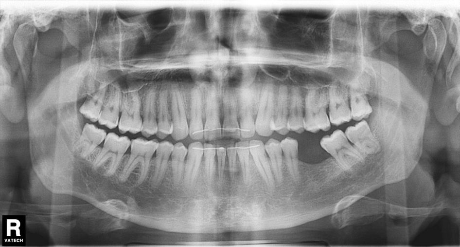 ¿Un paciente puede usar ortodoncia si ya lleva implantes? dental morante implantes en madrid