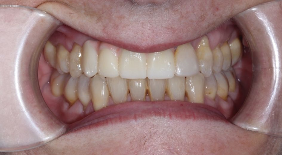 ¿Un paciente puede usar ortodoncia si ya lleva implantes? dental morante implantes en madrid