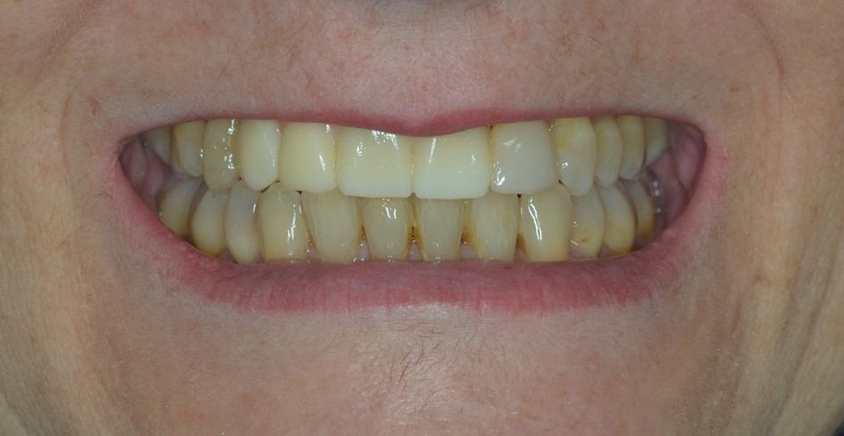 ¿Un paciente puede usar ortodoncia si ya lleva implantes? dental morante implantes en madrid