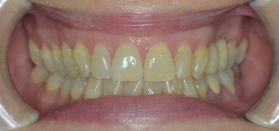 ¿Un paciente puede usar ortodoncia si ya lleva implantes? dental morante implantes en madrid