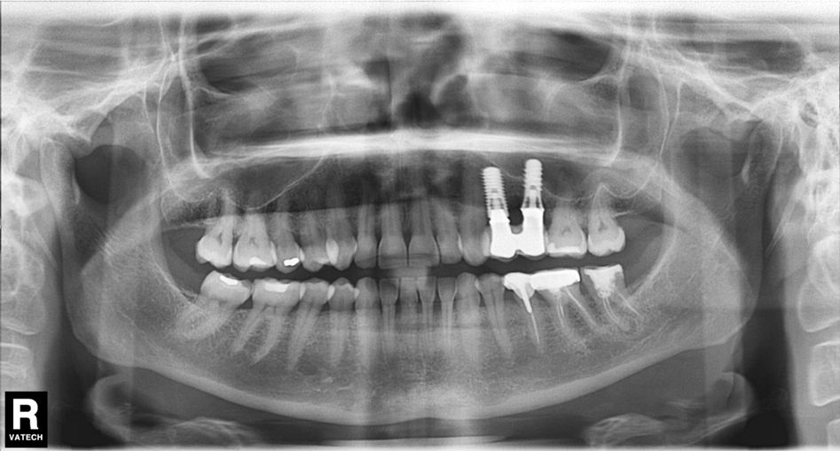 ¿Un paciente puede usar ortodoncia si ya lleva implantes? dental morante implantes en madrid