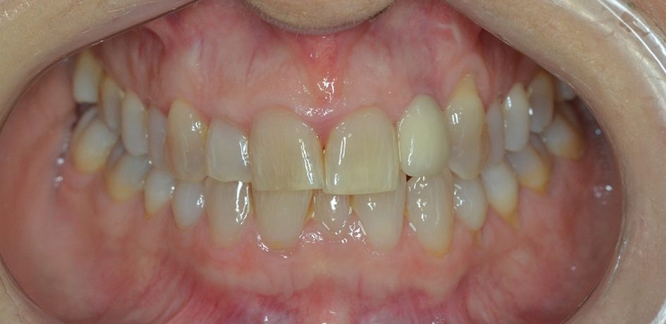 ¿Un paciente puede usar ortodoncia si ya lleva implantes? dental morante implantes en madrid