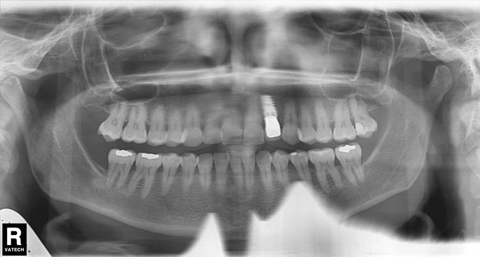 ¿Un paciente puede usar ortodoncia si ya lleva implantes? dental morante implantes en madrid