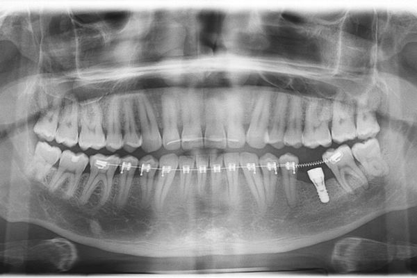 ¿Un paciente puede usar ortodoncia si ya lleva implantes?