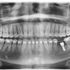 ¿Un paciente puede usar ortodoncia si ya lleva implantes?