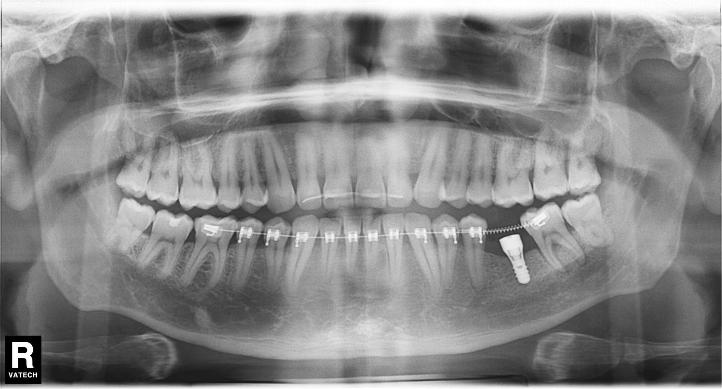 ¿Un paciente puede usar ortodoncia si ya lleva implantes?