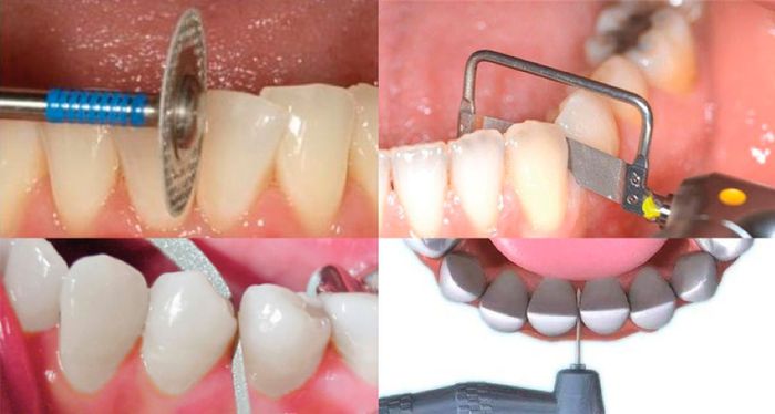 ¿Qué es el Stripping o IPR? ¿Te ha dicho tu ortodoncista que necesita hacerlo en tus dientes para que tu tratamiento sea efectivo? ¿Quieres saber en qué consiste?