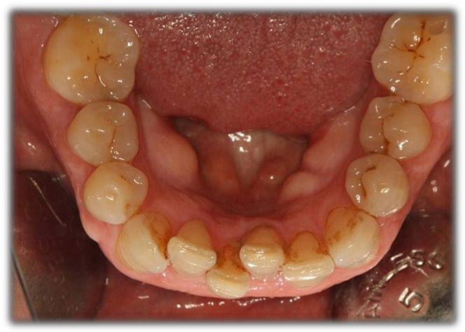 ¿Qué es el Stripping o IPR? ¿Te ha dicho tu ortodoncista que necesita hacerlo en tus dientes para que tu tratamiento sea efectivo? ¿Quieres saber en qué consiste?