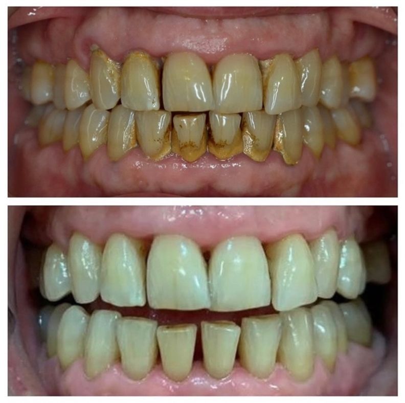 ¿Qué es el tratamiento periodontal? Fases del tratamiento periodontal