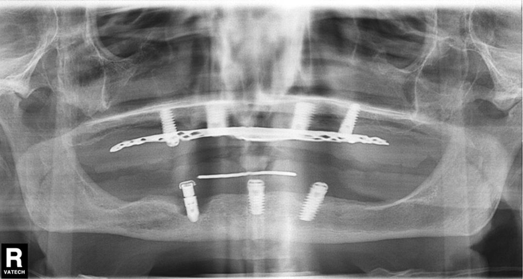 ¿Qué es el tratamiento periodontal? Fases del tratamiento periodontal