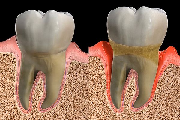 ¿Qué es el tratamiento periodontal? Fases del tratamiento periodontal
