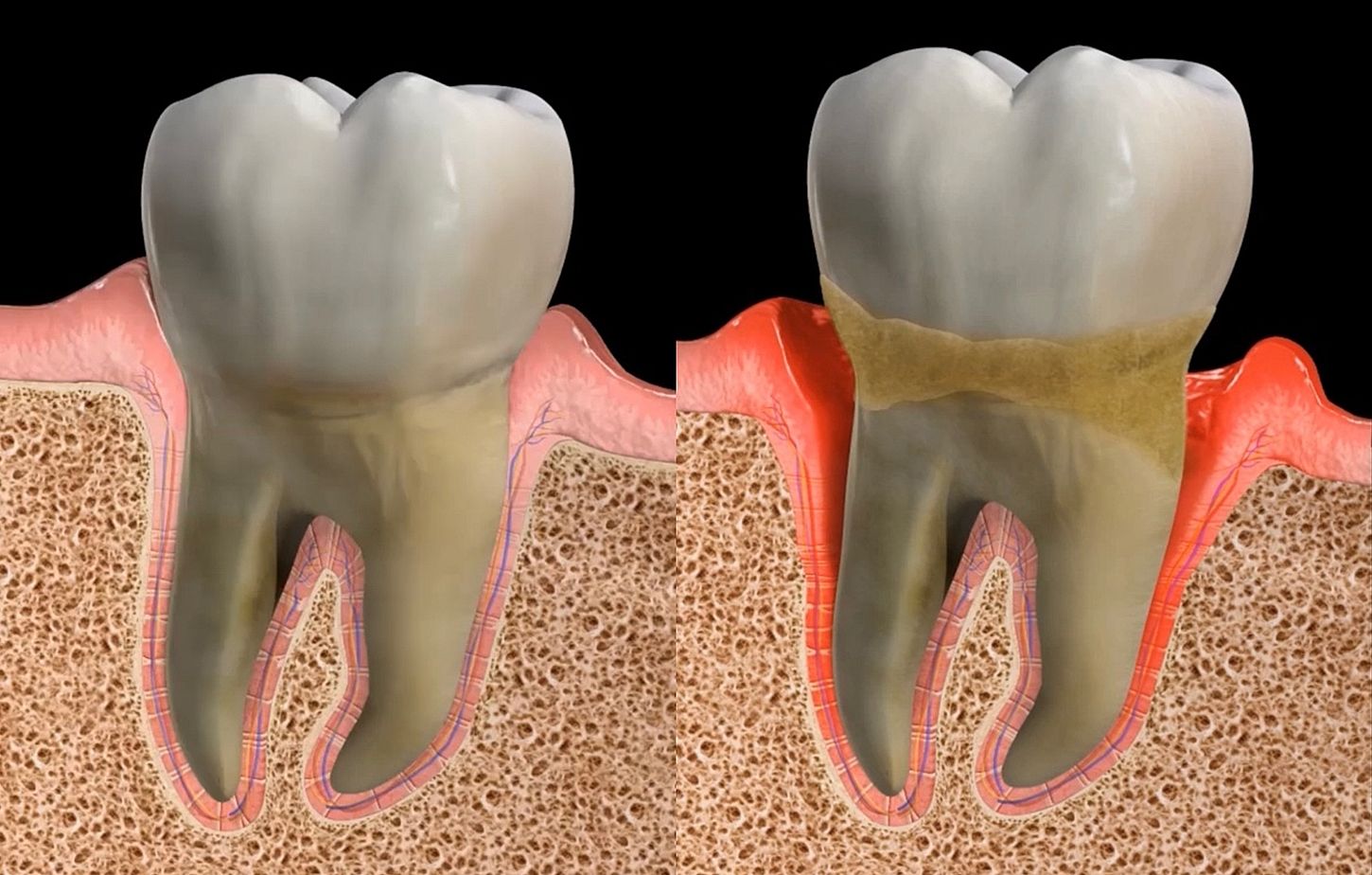 ¿Qué es el tratamiento periodontal? Fases del tratamiento periodontal