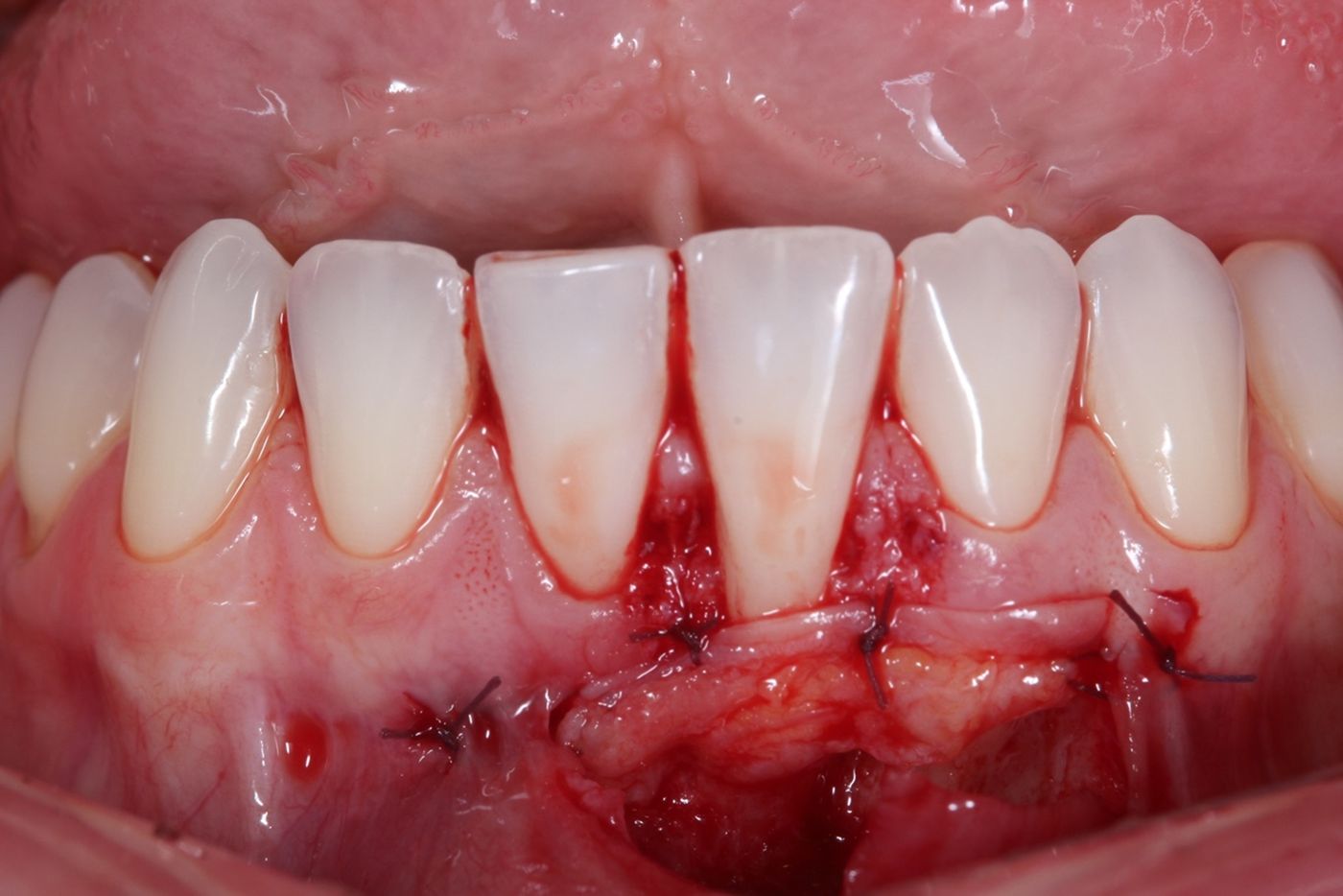 recesión de encía injerto gingival