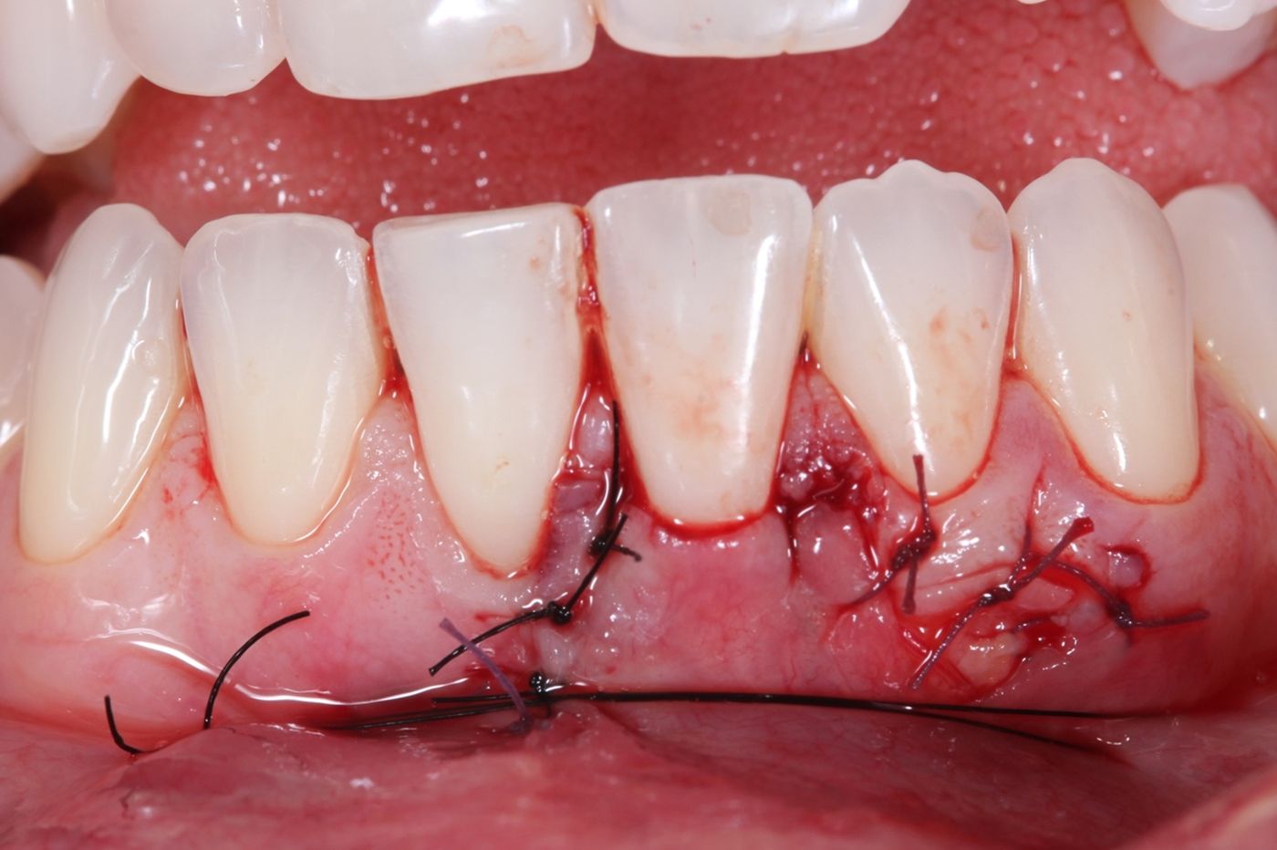 recesión de encía injerto gingival