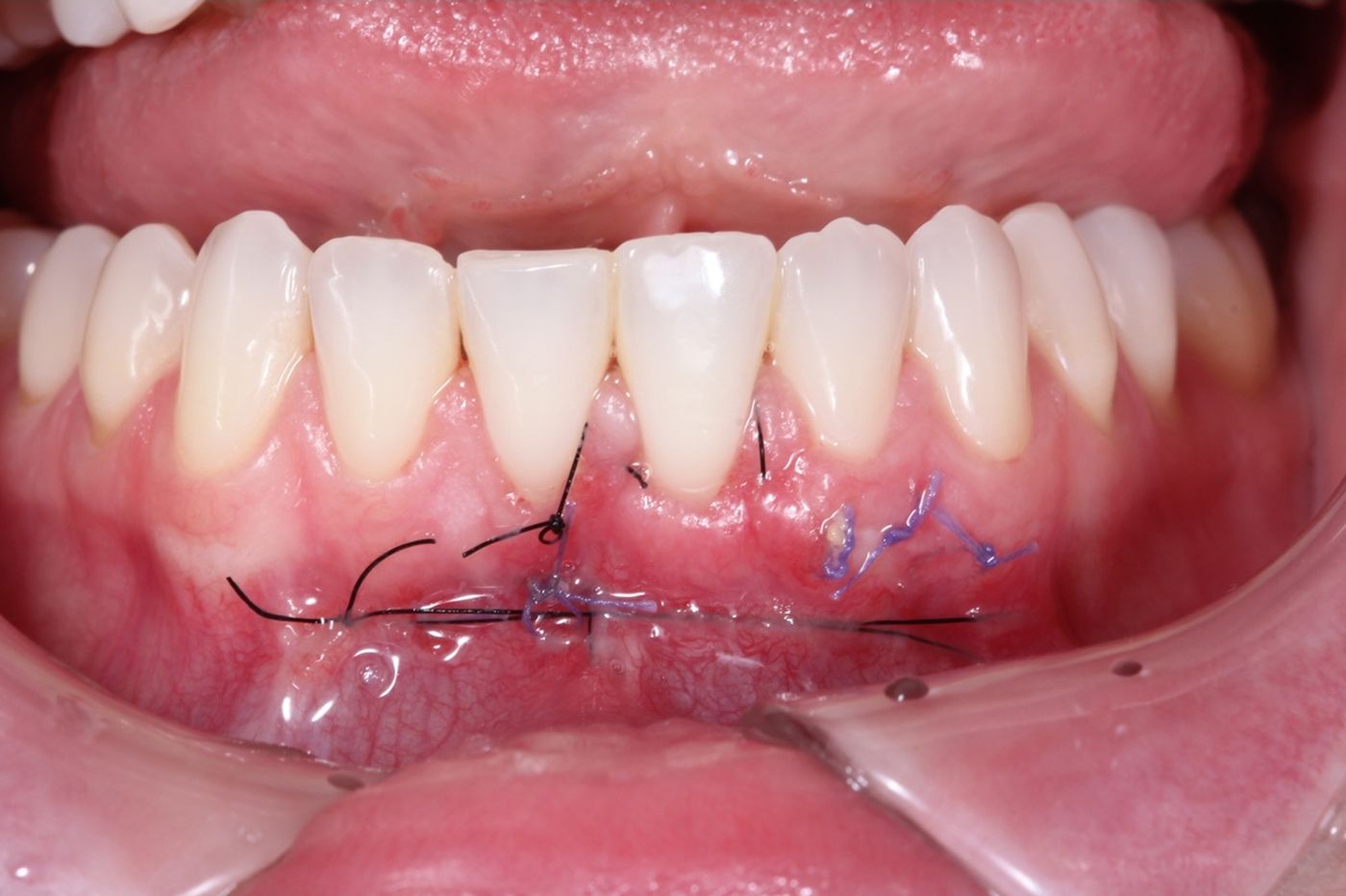 recesión de encía injerto gingival