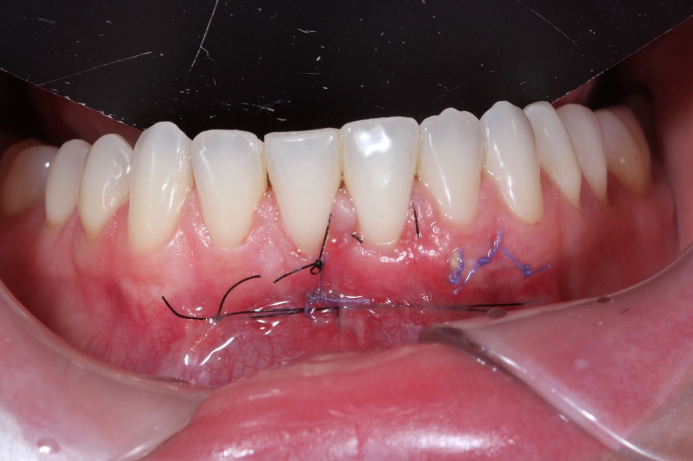 recesión de encía injerto gingival