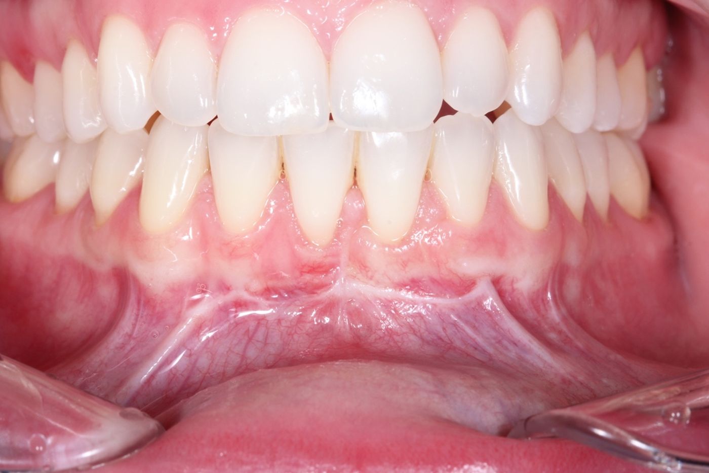 recesión de encía injerto gingival