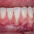 ¿Tienes recesión de encía? ¿Te han recomendado hacerte un injerto gingival? ¿Quieres saber en qué consiste?