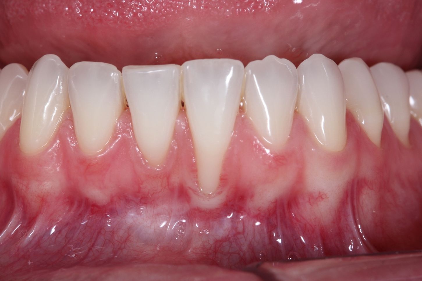 ¿Tienes recesión de encía? ¿Te han recomendado hacerte un injerto gingival? ¿Quieres saber en qué consiste?