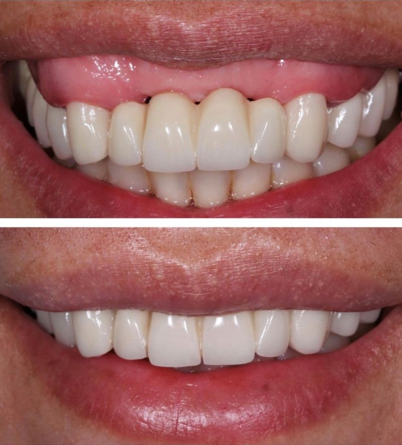 reposicionamiento labial sonrisa gingival dental morante implantes en madrid