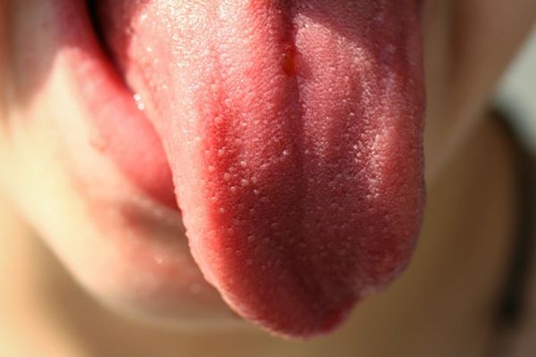 El Síndrome de la Boca Ardiente o Glosodinia. La enfermedad que hace que la lengua queme.
