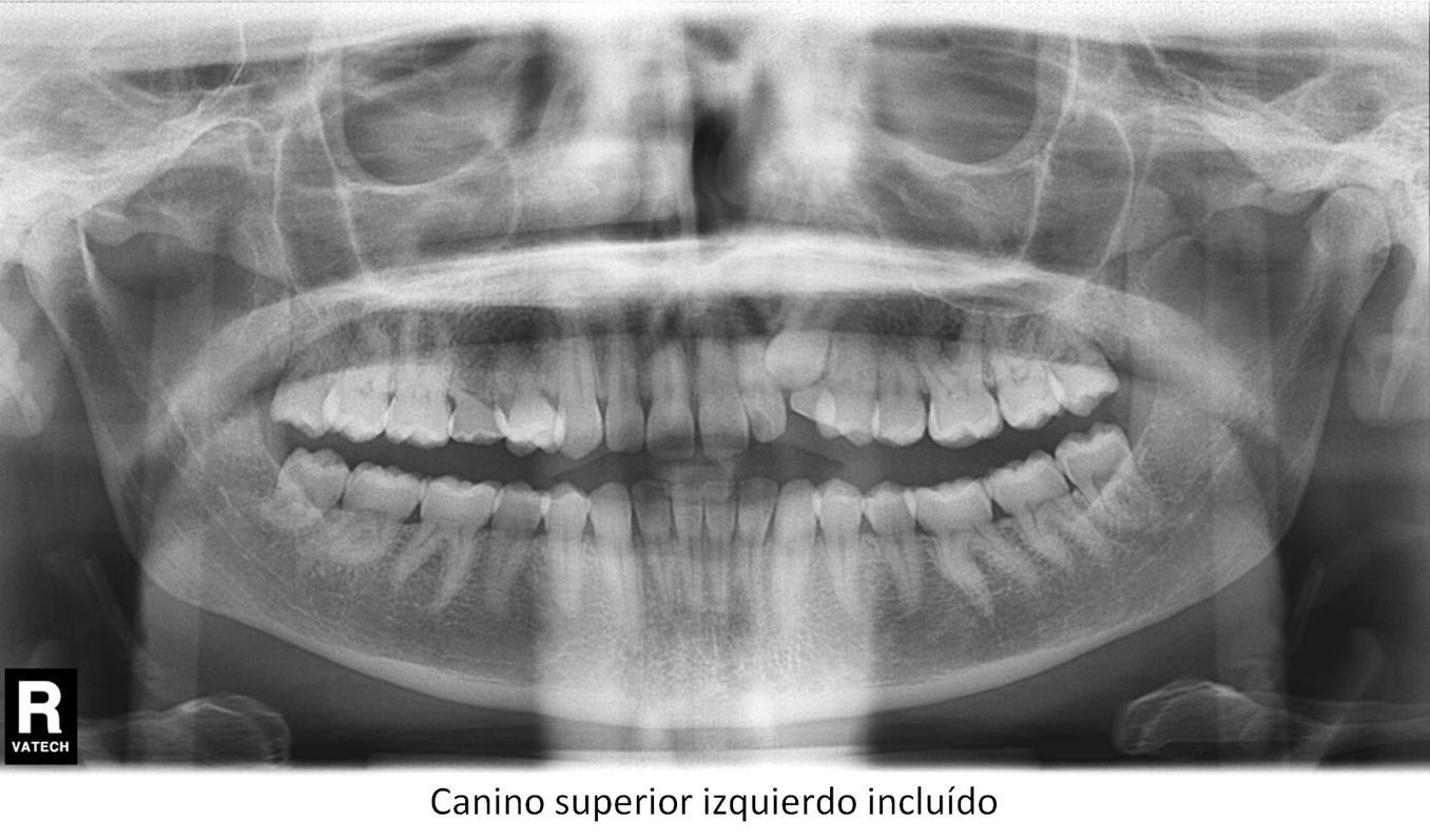 Trastornos de la erupción Dientes incluídos