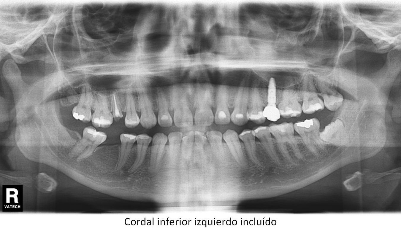 Trastornos de la erupción Dientes incluídos