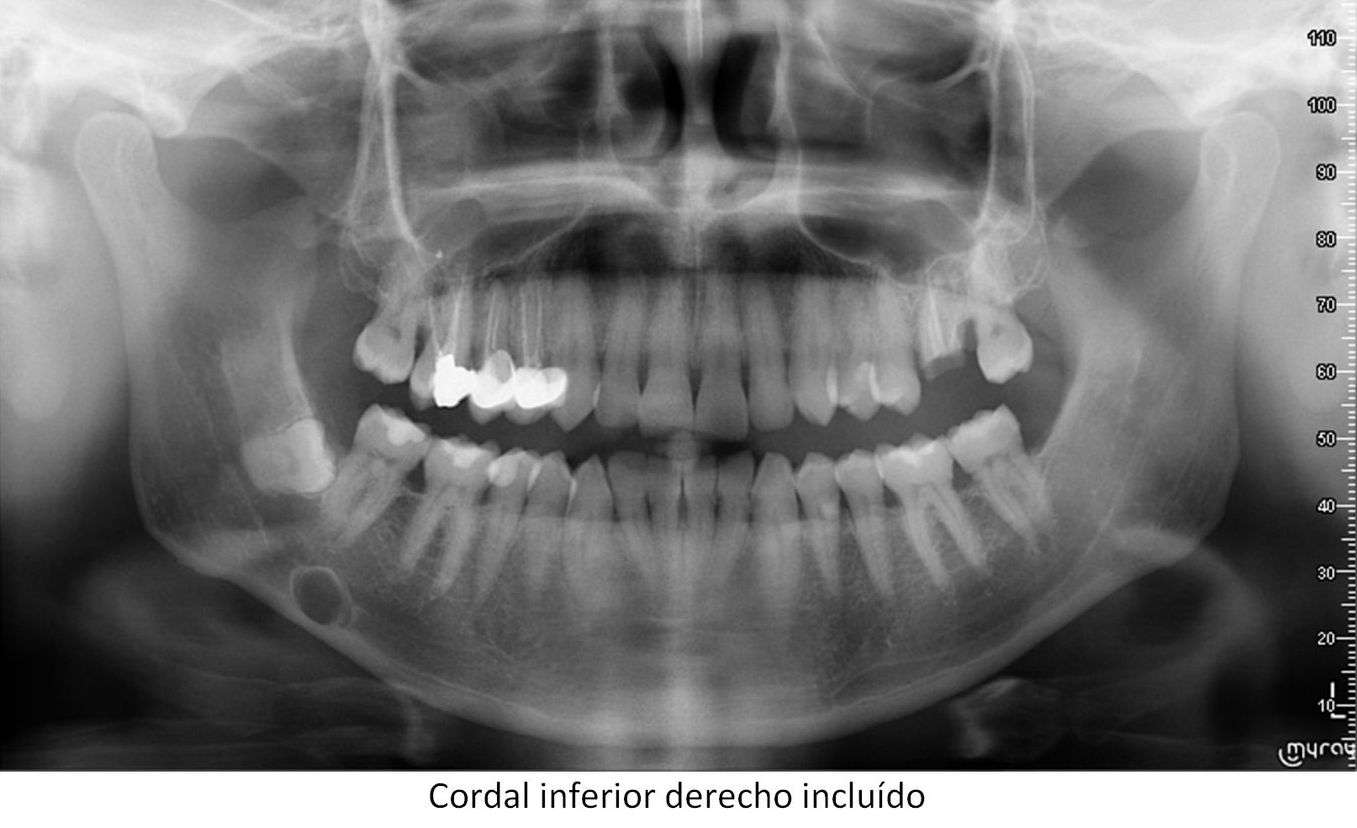 Trastornos de la erupción Dientes incluídos