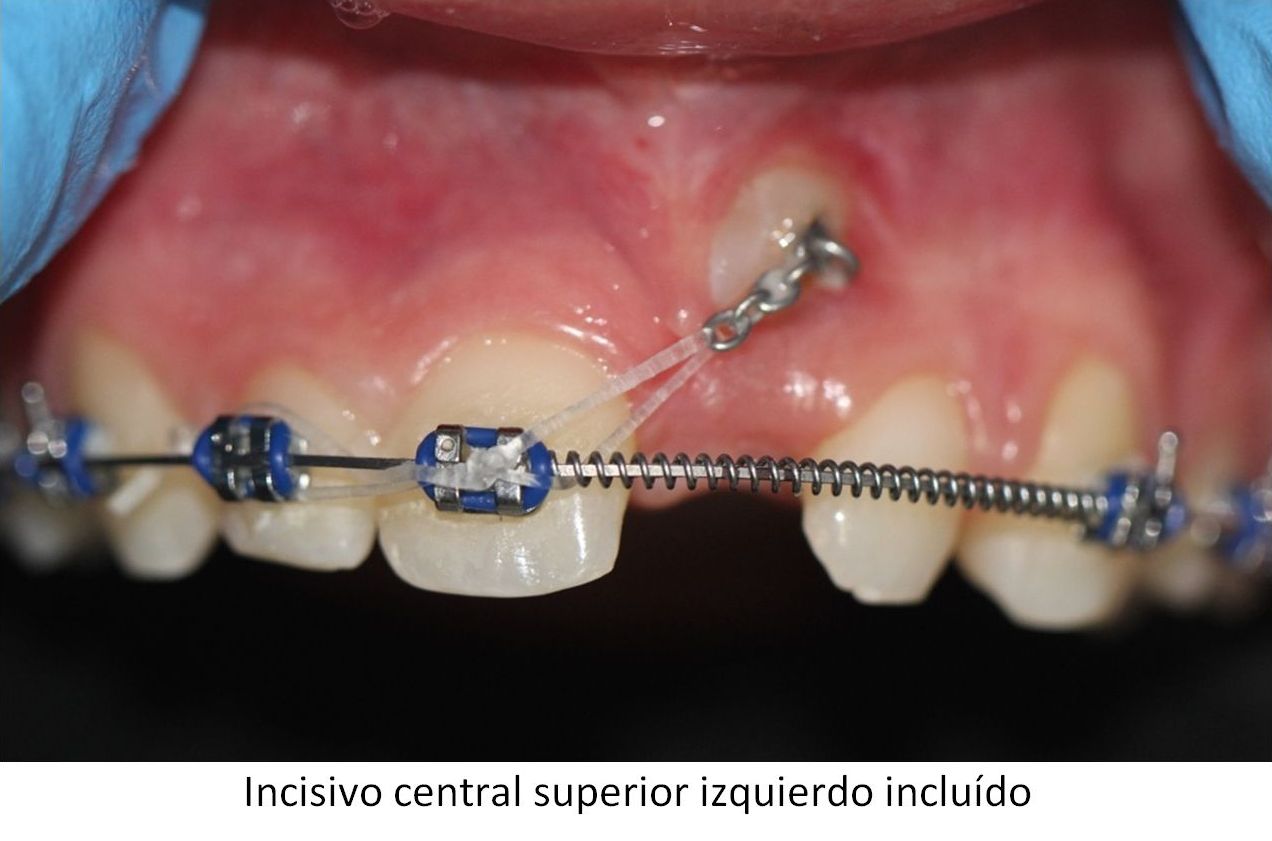 Trastornos de la erupción Dientes incluídos