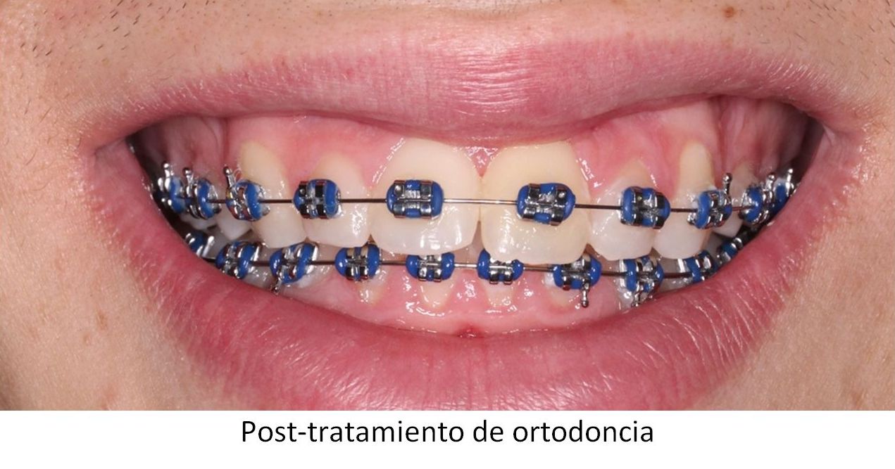 Trastornos de la erupción Dientes incluídos