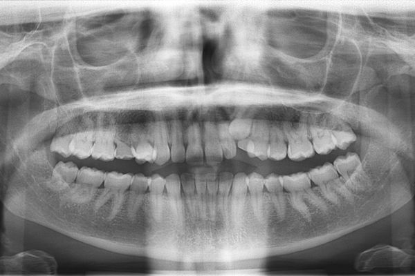 Trastornos de la erupción. Dientes incluídos