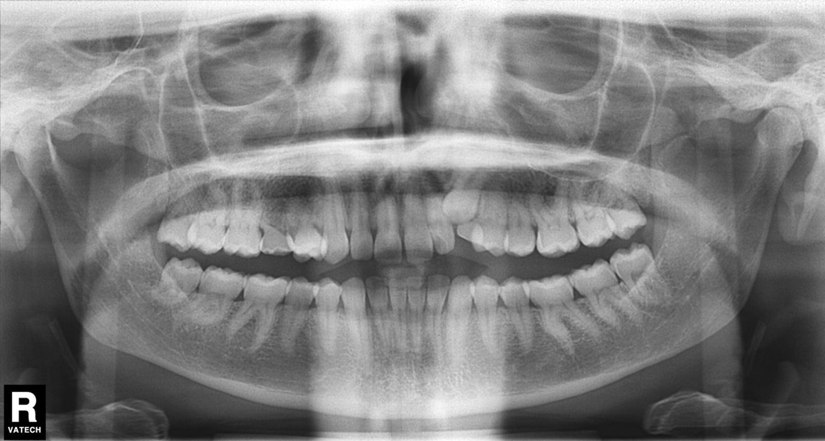 Trastornos de la erupción. Dientes incluídos