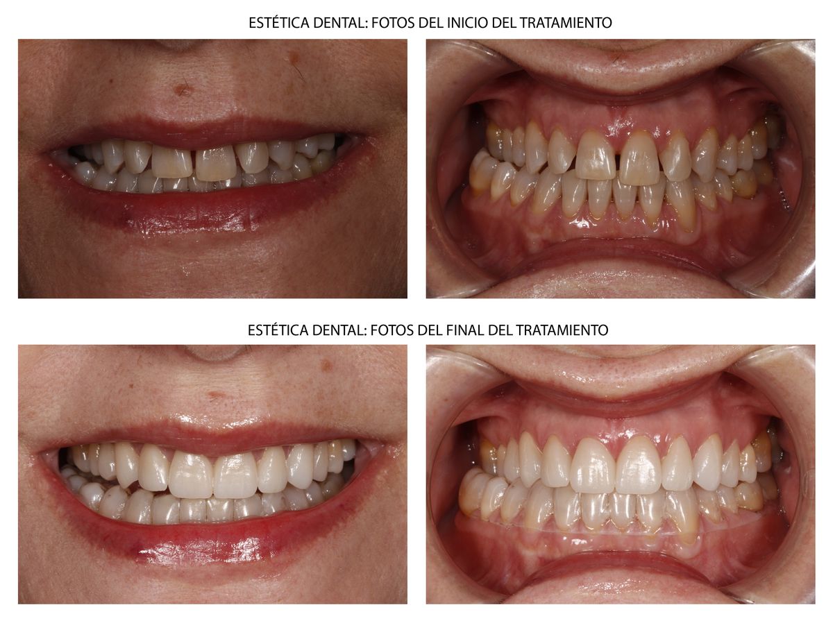 caso clinico estetica dental Carillas de composite