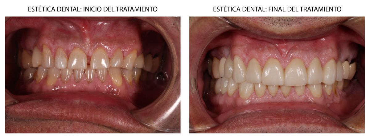 caso clinico estetica dental Carillas de composite