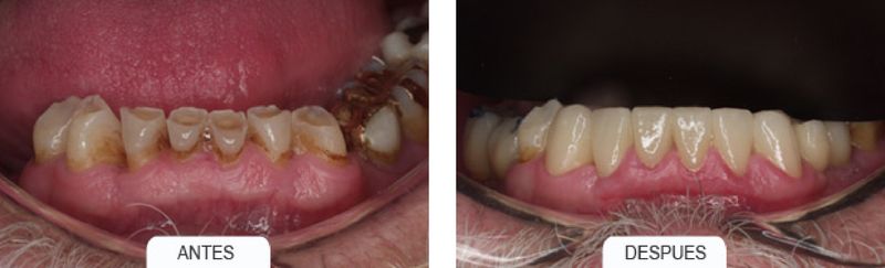 caso clinico estetica dental Coronas totalmente de cerámica