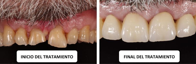 caso clinico estetica dental Coronas totalmente de cerámica