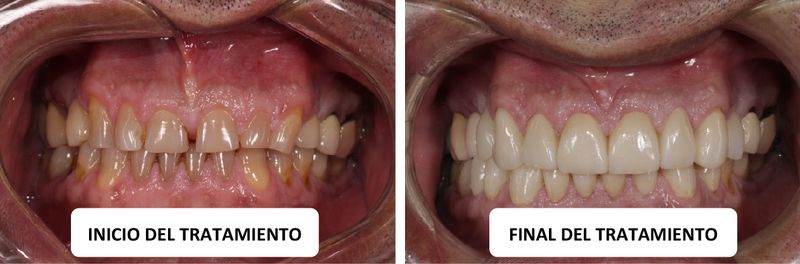 caso clinico estetica dental Coronas totalmente de cerámica