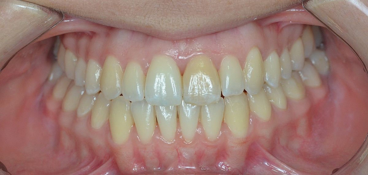 despues ortodoncia invisible Dental Morante