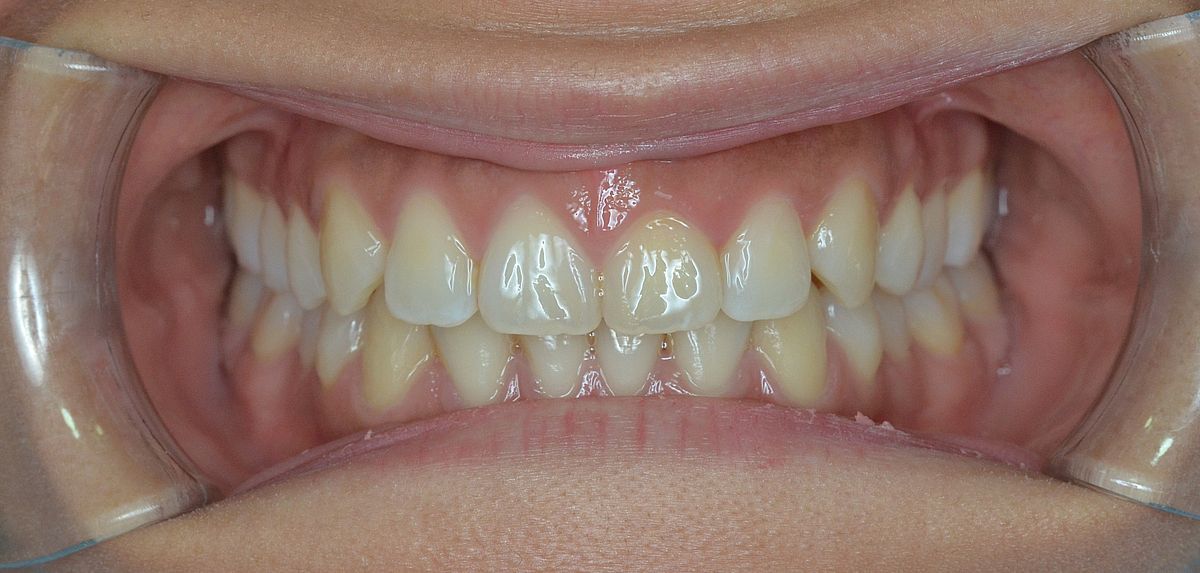 despues ortodoncia invisible Dental Morante