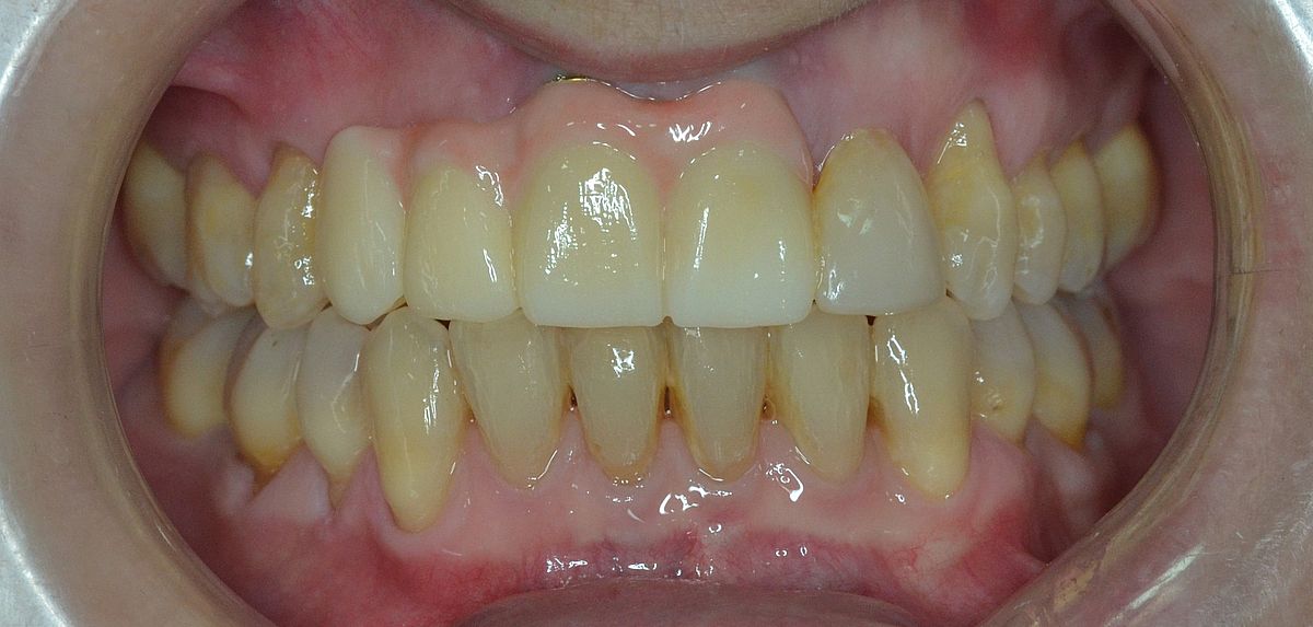 despues ortodoncia invisible Dental Morante