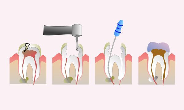 Endodoncia