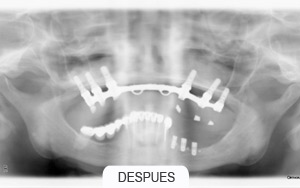 Implantes