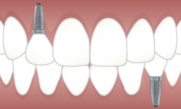 mejores implantes dentales madrid deantal morante